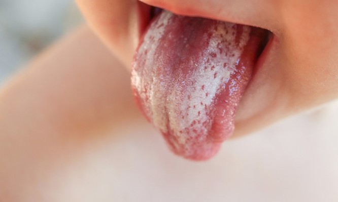 Τι μπορεί να σημαίνει η λευκή γλώσσα στο παιδί – Μην το αμελήσετε - Media