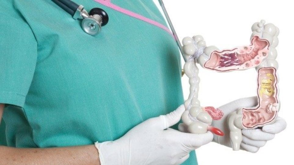 Καρκίνος Παχέος Εντέρου: Πώς μπορεί να προληφθεί – Η εξέταση που σώζει ζωές - Media