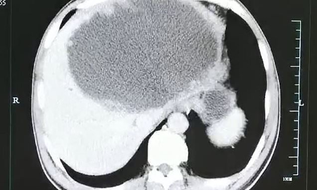 Συγκλονιστική ακτινογραφία: Έτρωγε ωμά ψάρια και το συκώτι του γέμισε με αυγά σκουληκιών και πύον  - Media