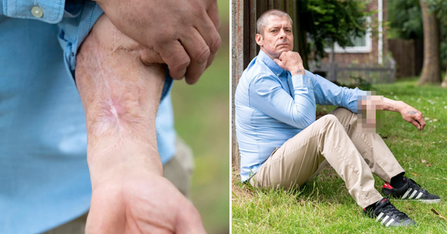 Ο άνδρας που στον πήχη του χεριού του μεγαλώνει ένα… πέος – Το έχει ονομάσει Τζίμι (Video) - Media