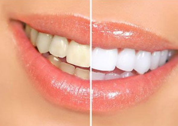 Νέα «μόδα» η λεύκανση δοντιών στο σπίτι - Προειδοποιούν οι οδοντίατροι (Video) - Media