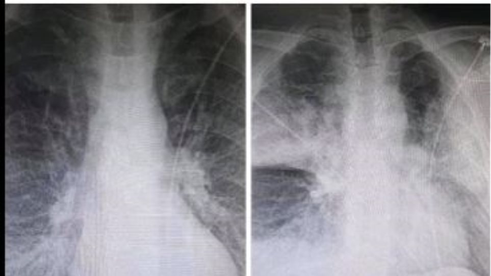 Καθηγητής πνευμονολογίας αναλύει τι βλέπει στην ακτινογραφία-σοκ 38χρονου με κορωνοϊό - Media