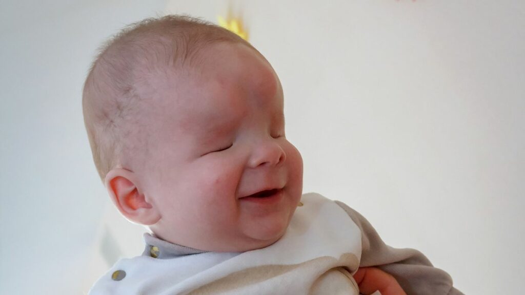 Το μωρό χωρίς μάτια που συνεχώς χαμογελάει βρήκε σπίτι – το εγκατέλειψε η μητέρα του μόλις γεννήθηκε  - Media