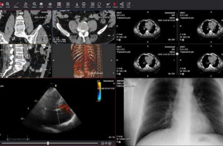 DeepCOVID-XR: Η εξέταση που ανιχνεύει τον κορωνοϊό δέκα φορές πιο γρήγορα από τα τεστ - Media