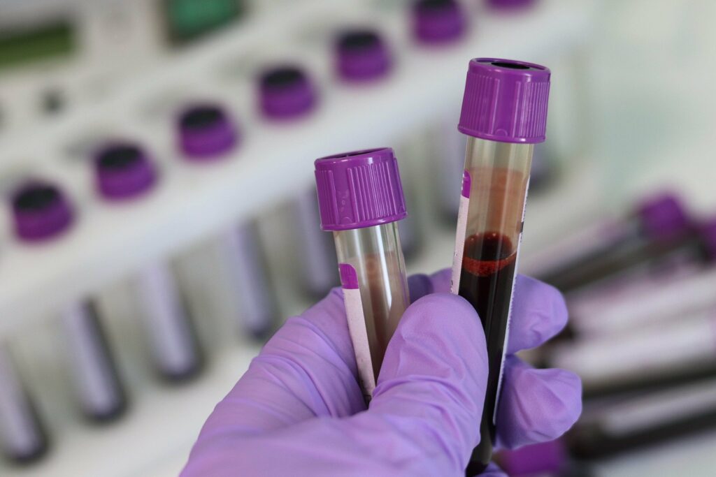 Κορωνοϊός: Ποια ομάδα αίματος παρουσιάζει μειωμένο κίνδυνο για όσους την έχουν να κολλήσουν ή να νοσήσουν βαριά - Media