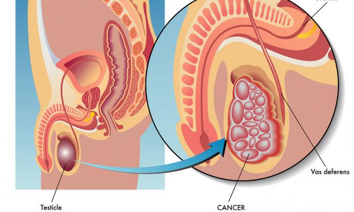 Καρκίνος των όρχεων: «Αυξάνουν τον κίνδυνο οι πολλές ακτινογραφίες και αξονικές τομογραφίες » - Media