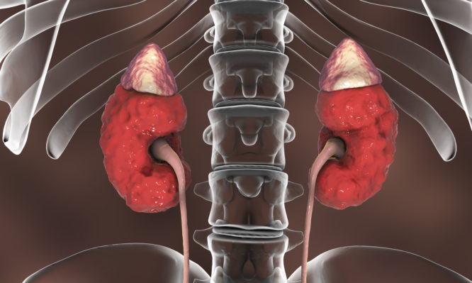 Νεφρική ανεπάρκεια: Αυτά είναι τα επικίνδυνα σημάδια - Media