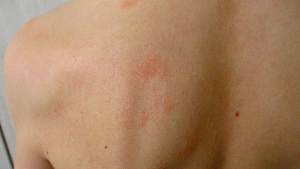 exanthima