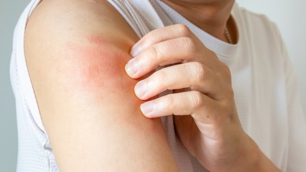 eczema_new