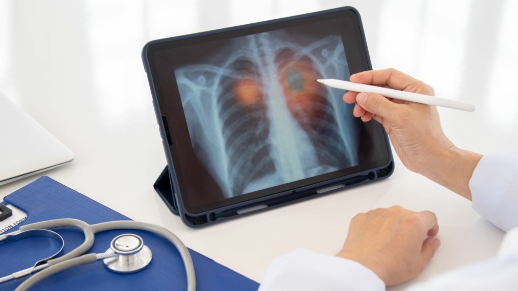 lung_cancer_new