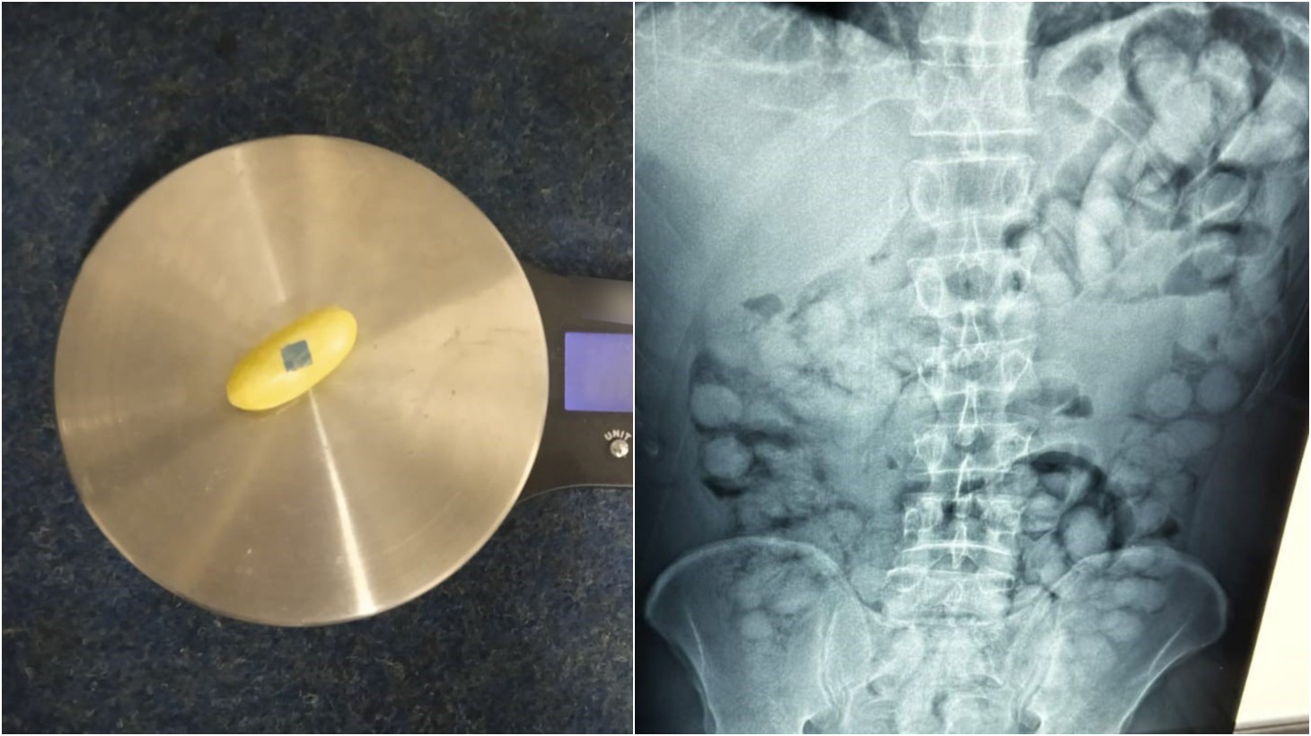 Na atenskem letališču prijeli Brazilca s stotimi "jajčki" kokaina v telesu