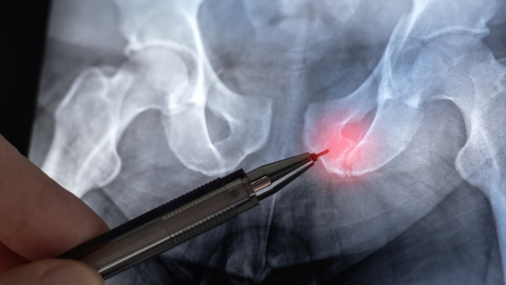 pelvic_fracture_new