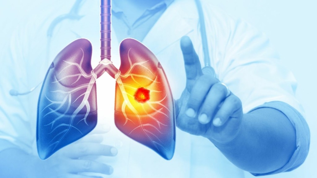 karkinos_pneumona_new