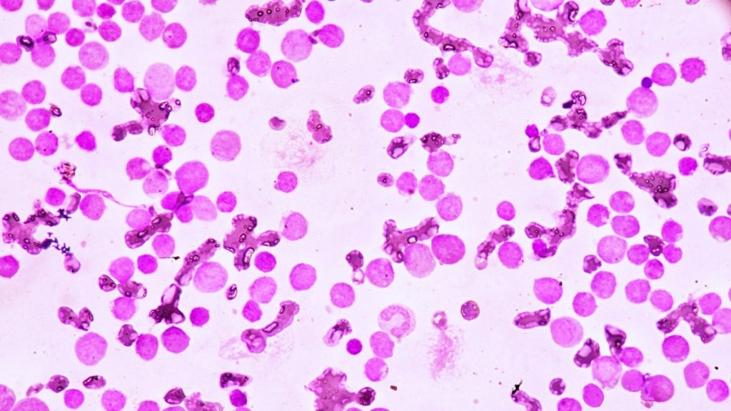 acute-myeloid-leukemia_0604_1920-1080_new