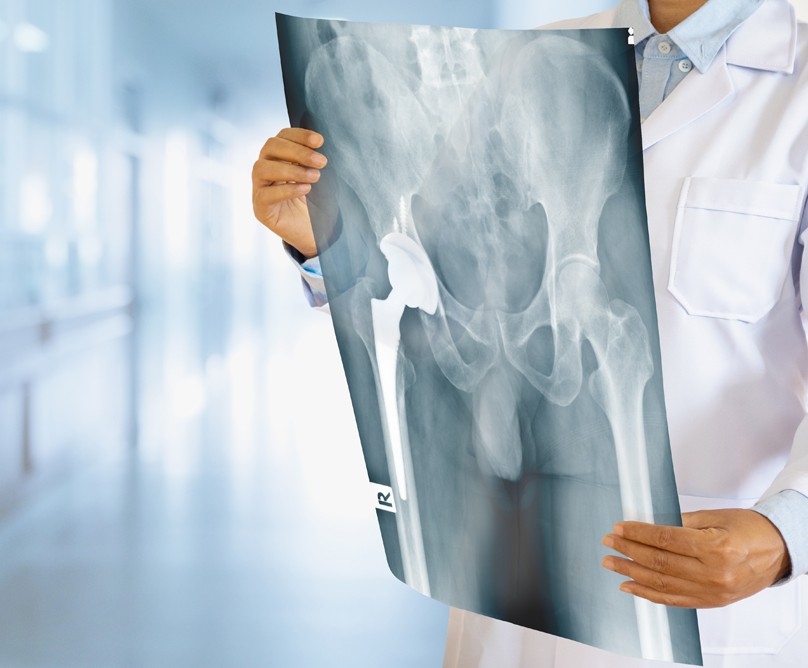 arthroplastiki isxios foto