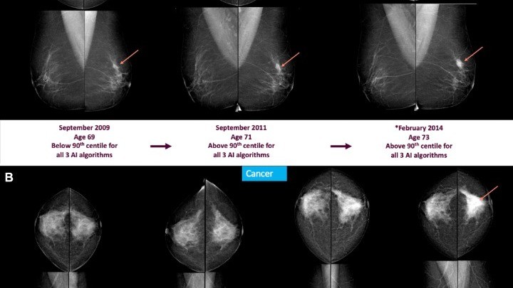 CREDIT: Radiological Society of North America (RSNA)